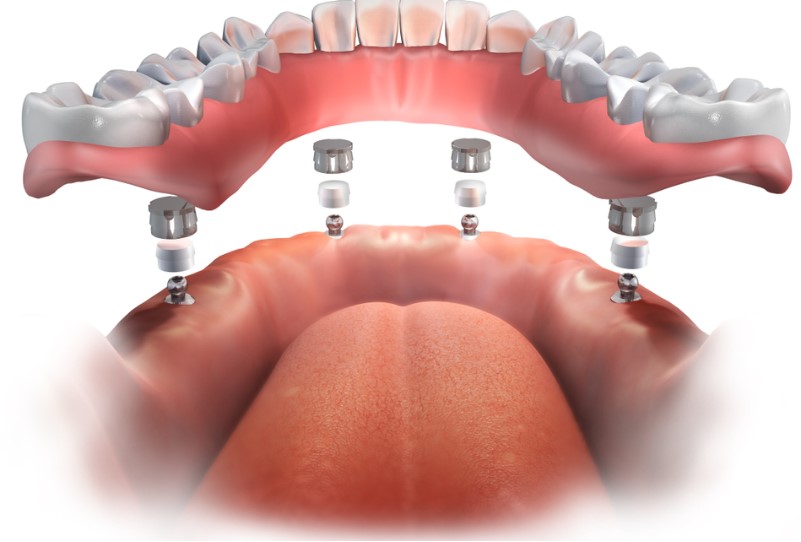 all-on-4 dental implants