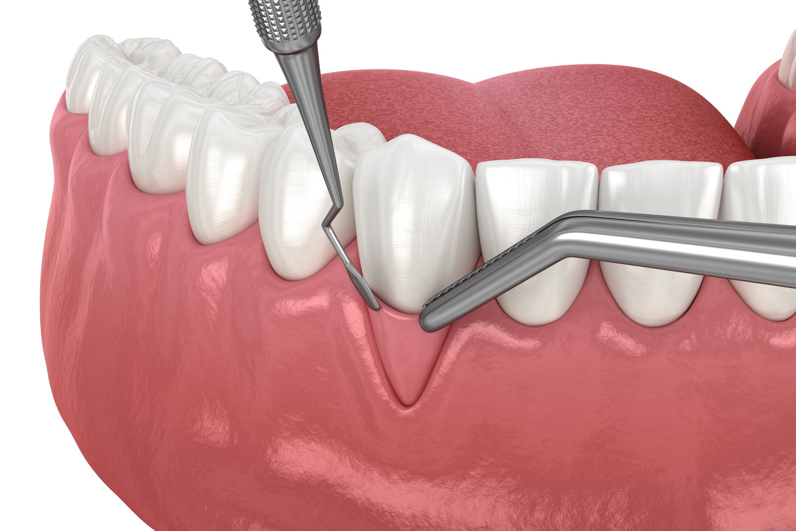 gum-disease2